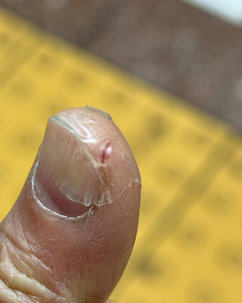 ひび割れストップバン